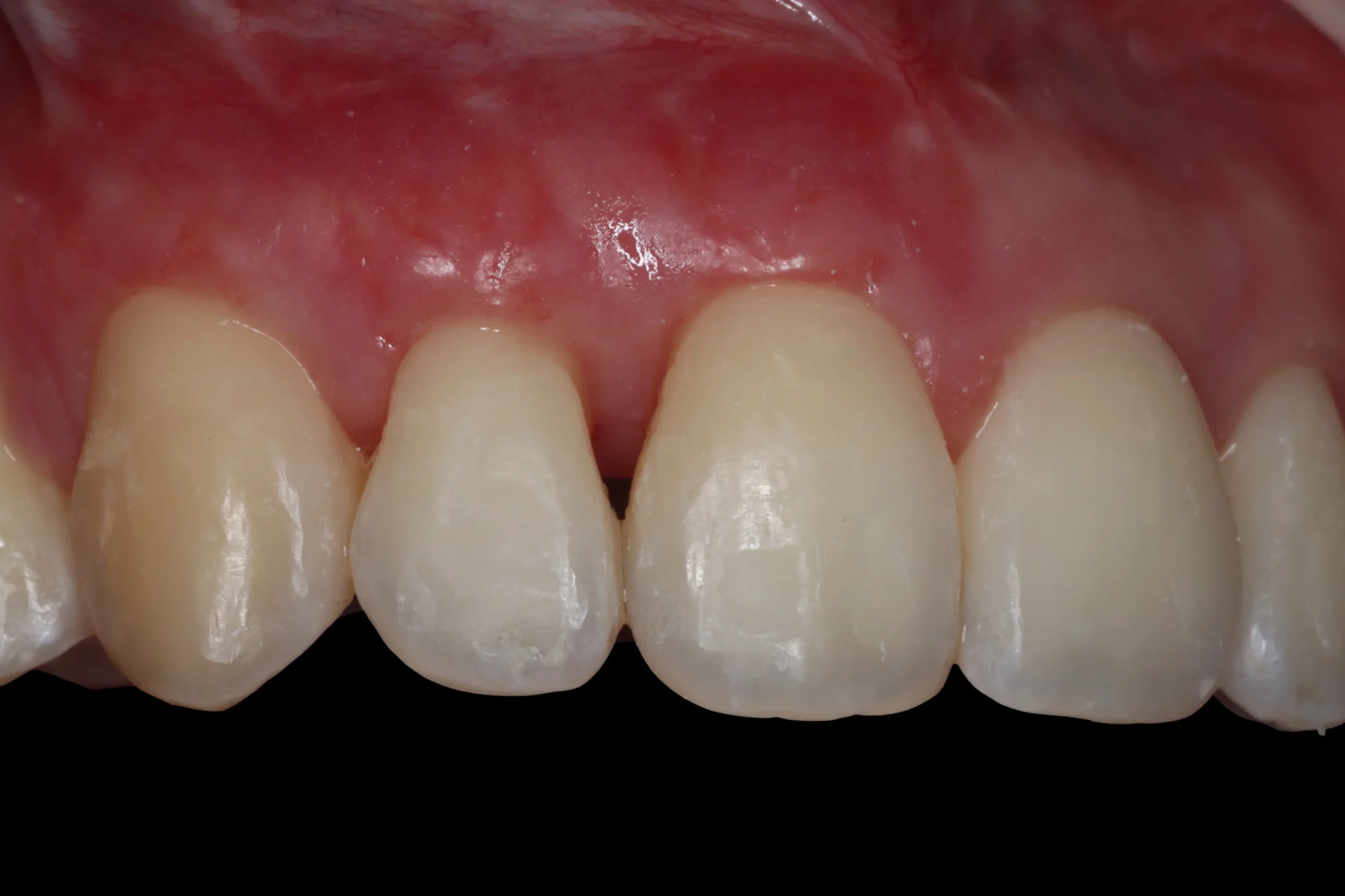 After gum graft After gum graft