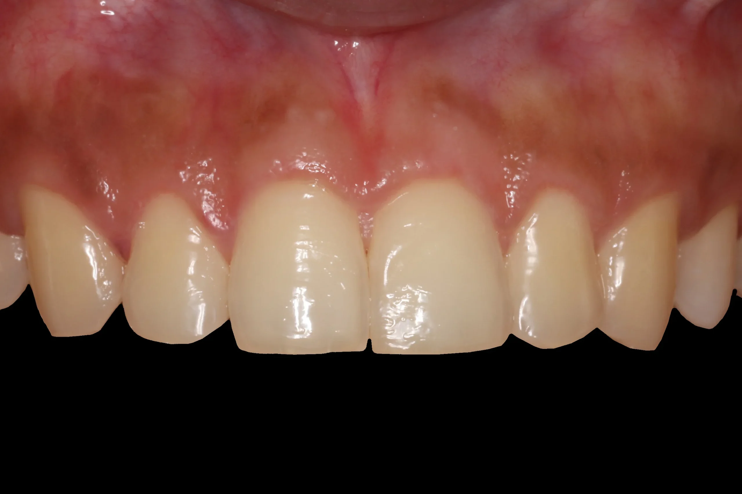 After gum surgery After gum surgery