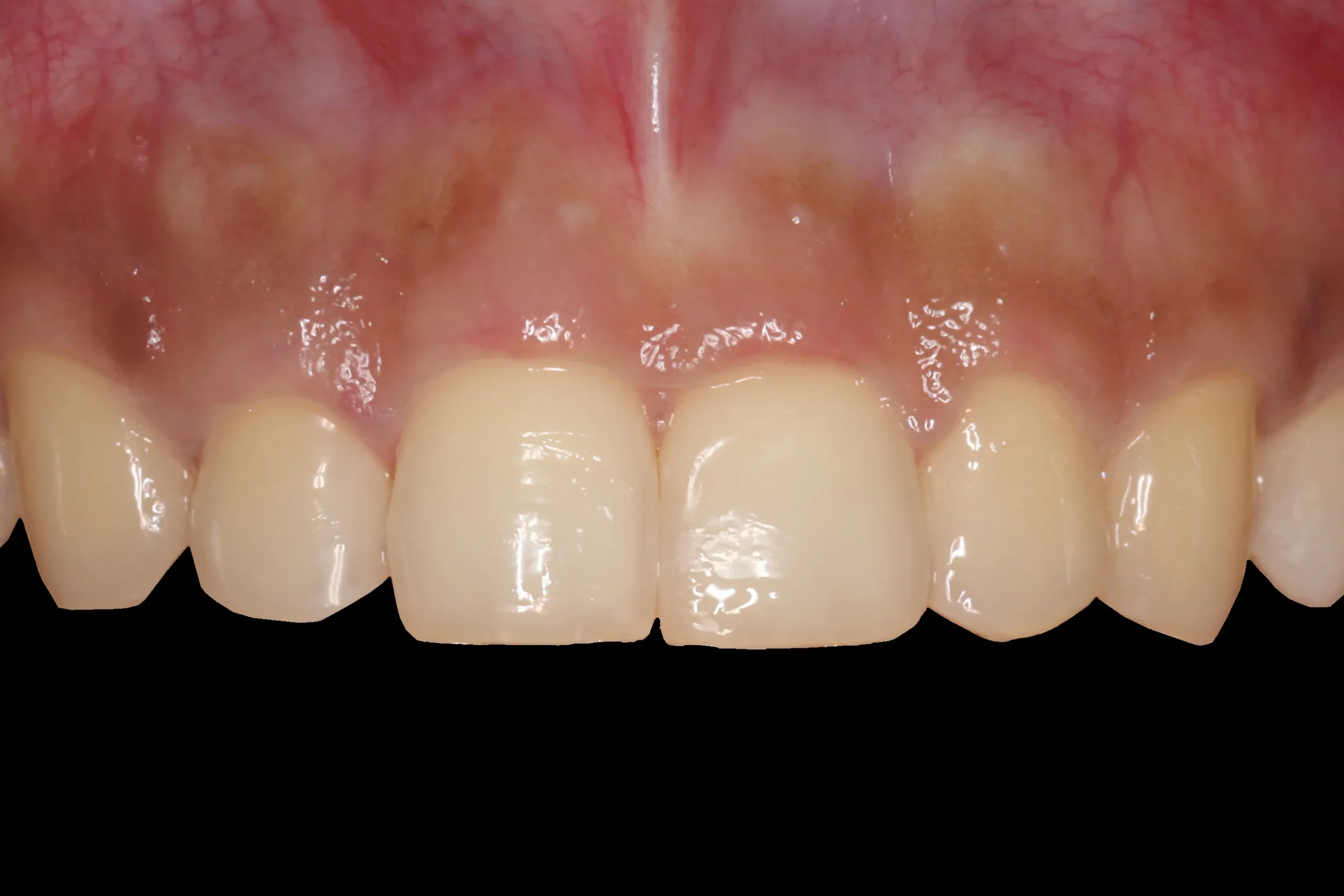 Before gum surgery Before gum surgery