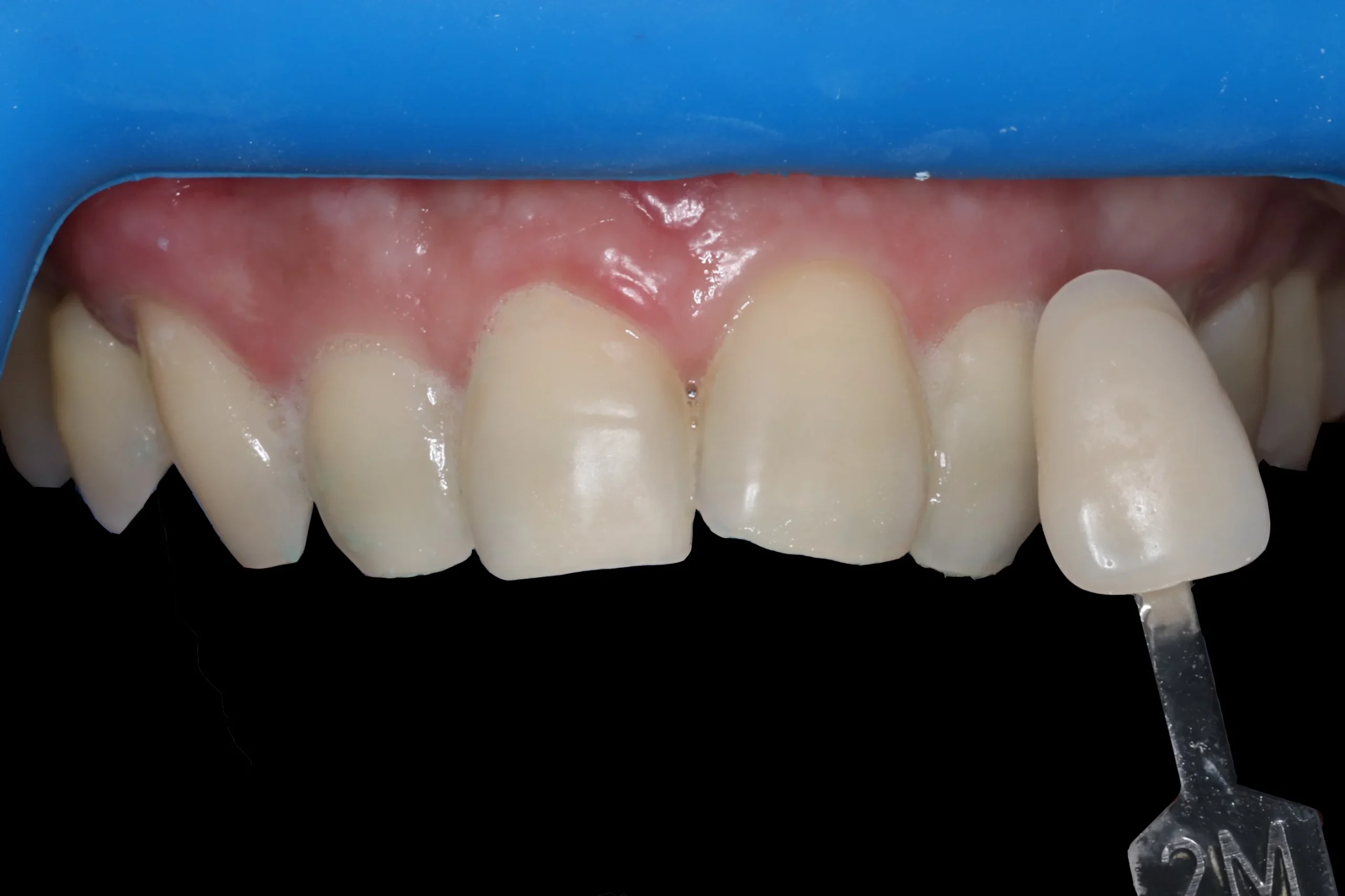 Before tooth whitening Before tooth whitening