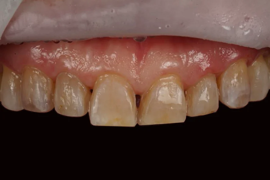 Before veneer Before veneer